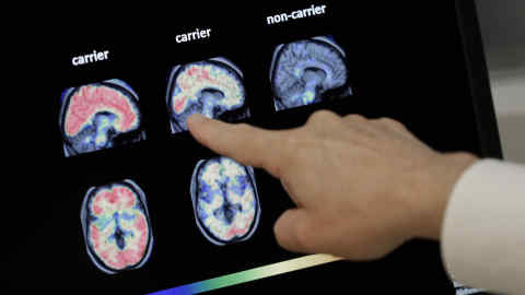 FILE - In this Aug. 14, 2018 file photo, Dr. William Burke goes over a PET brain scan at Banner Alzheimers Institute in Phoenix. The drug company Biogen Inc. says it will seek federal approval for a medicine to treat early Alzheimer's disease, a landmark step toward finding a treatment that can alter the course of the most common form of dementia. The announcement Tuesday, Oct. 22, 2019, is a surprise because the company earlier this year stopped two studies of the drug, called aducanumab, after partial results suggested it was not working. (AP Photo/Matt York, File)