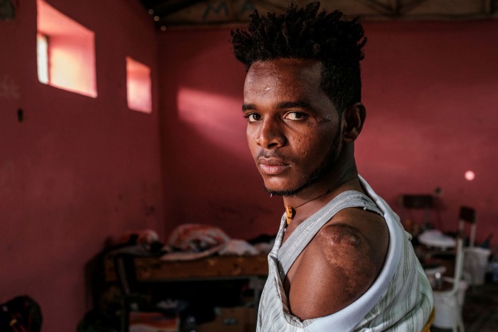 Gezae Wolderaphael, who is sheltering in a school in the Tigrayan capital Mekelle, shows his scars sustained in the attack on Mai Kadra