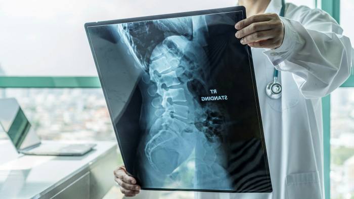 Surgical doctor looking at radiological spinal x-ray film