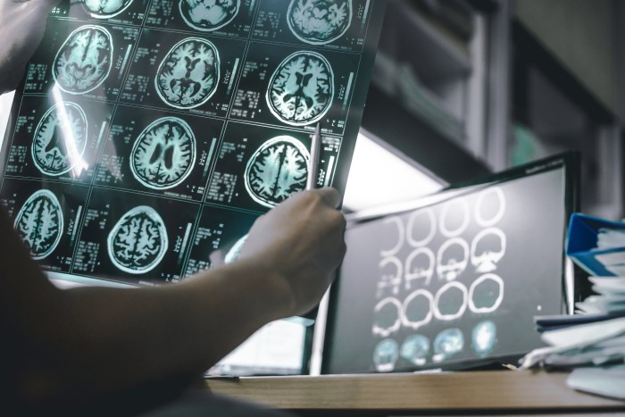 A medical worker holds a sequence of MRI brain scan images