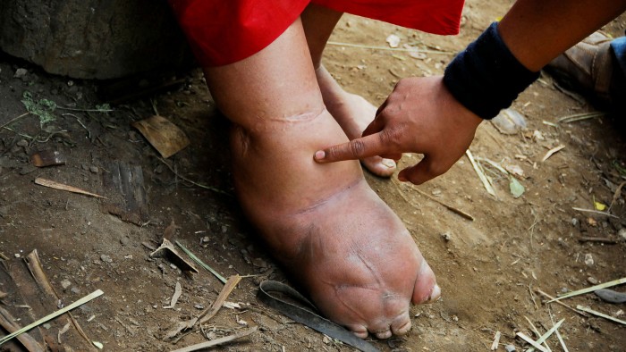 Lymphatic filariasis: elephantiasis causes disability and disfigurements in more than 36m people globally
