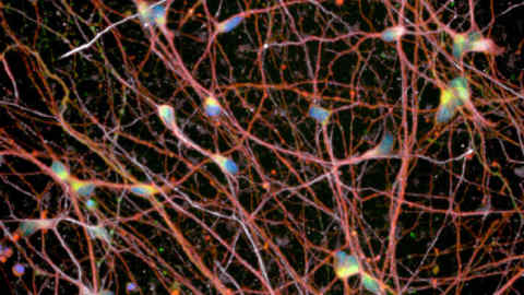 Motor Neuron Disease - Image1 is motor neurons
