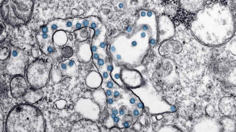 This 2020 electron microscope image made available by the U.S. Centers for Disease Control and Prevention shows the spherical particles of the new coronavirus, colorized blue, from the first U.S. case of COVID-19. Antibody blood tests for the coronavirus could play a key role in deciding whether millions of Americans can safely return to work and school. But public health officials warn that the current ‚ÄúWild West‚Äù of unregulated tests is creating confusion that could ultimately slow the path to recovery. (Hannah A. Bullock, Azaibi Tamin/CDC via AP)